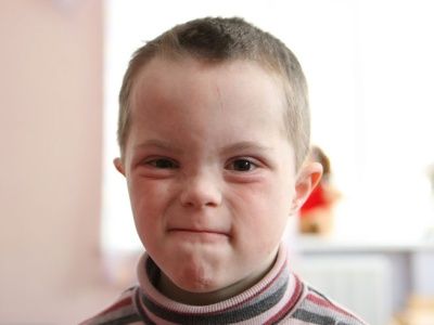 Ребенок с синдромом Дауна. Фото: sunchildren.narod.ru Ребенок с синдромом Дауна. Фото: sunchildren.narod.ru