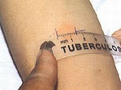 Туберкулез. Фото: scientific.ru Туберкулез. Фото: scientific.ru